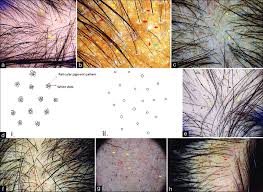 a) Trichoscopy of androgenetic alopecia shows numerous ...