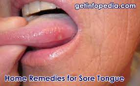 Home Remedies For Treating Sore Tongue Getinfopedia Com Tongue Sores Tongue Ulcer Remedies Sore Tongue Remedies