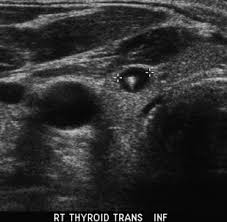 Calcifications) then hypoechoic nodules are typically biopsied after reaching size criteria; Ultrasound Of Thyroid Nodules Sciencedirect
