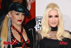 There are countless reports online suggest that gwen has had works done. Gwen Stefani Before And After Facelift Celebrity Plastic Surgery Gwen Stefani Plastic Surgery