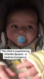 Image result for Infantile Spasms