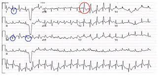 V této části naleznete celou řadu textů a ukázek ekg, velmi dobře poslouží k naučení se základů této problematiky. Akutni Embolie Ekg Medicina Nemoci Studium Na 1 Lf Uk
