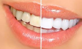 Cara memutihkan gigi kuning secara mudah dan cepat. Cara Memutihkan Gigi Kuning Dalam 3 Menit Dengan Pasta Lemon Mercinews