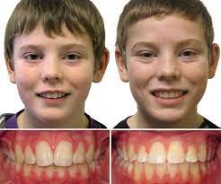 Overbite braces