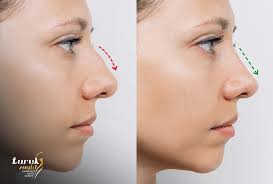 مراحل تغير الأنف بعد عملية التجميل - دكتور طارق زايد