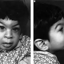 PDF) The mitochondrial genome in Wolfram syndrome