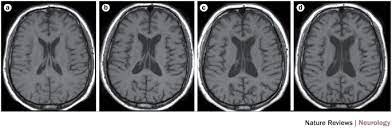 The presence of multiple lesions in cns locations commonly affected by ms, along with the presence of both enhancing and nonenhancing lesions, can facilitate a diagnosis of ms at the time of a first attack, whereas the accrual of serial lesions or new clinical attacks over time confirms the. Magnims Consensus Guidelines On The Use Of Mri In Multiple Sclerosis Establishing Disease Prognosis And Monitoring Patients Nature Reviews Neurology