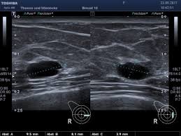 3d Ultraschall Elastographie Der Brust Gyn Julich