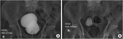 Image result for Voiding Cystourethrogram