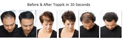 Hair loss causes & treatments. Genetic Hair Loss Male Pattern Baldness Toppikmalaysia