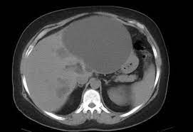 Polycystic Liver Disease Radiology Case Radiopaedia Org