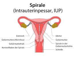 The triedre manufacturing process exploits the memory shape of the glass, the dough is first molded in triangle before being stretched by. Spirale Intrauterinpessar Iup Einsatz Wirkung Prognose