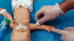 Canalización de vía venosa periférica en el recién nacido. 2021