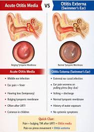 Image result for Acute Otitis Externa