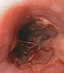 In contrast, cmv esophagitis often occurs as part of a disseminated cmv infection that can involve the stomach, intestine, and a number of other organs. Herpes Esophagitis Wikipedia