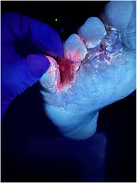 Image result for Erythrasma