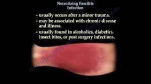 Recessed lighting installation necrotizing pancreatitis prognosis. Necrotizing Fasciitis Flesh Eating Disease Physiopedia