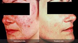 Their acne foam cleanser is great for rosacea sufferers. Rosacea Types Causes And Remedies