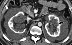 Renal Lymphangioma Multiple Bilateral Cystic Masses In The Perinephric Region And Renal Sinus Black Arrow Regions Radiology Renal Medical Education