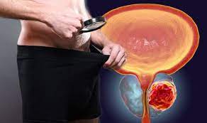 Prostate cancer is known to have a particular affinity for spreading or metastasizing to the bones especially the lower spine, pelvis, and femur. Prostate Cancer Symptoms If You See This In Your Semen Do Not Ignore Warning Sign Express Co Uk