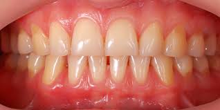 Common Causes Of Dark Gums | Cosmetic Dentist Dr. Alex Midtown NYC
