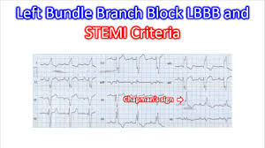 Image result for Left Bundle Branch Block