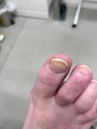 Image result for Beau lines feet