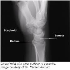 Image result for Wrist XRay