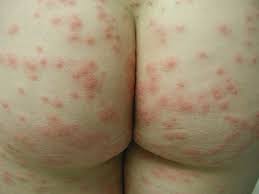 Read jane's story about one simple trick to end severe hives fast. Seabather S Eruption Dermatology Advisor