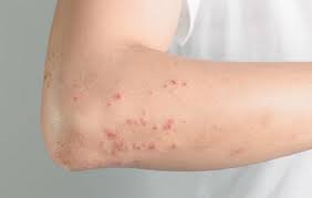 Apart from the red itchy bumps on the back of arms and other parts of the body, those with this skin condition are likely to experience the following symptoms. 7 Reasons Why You Might Be Breaking Out In Hives Women S Health