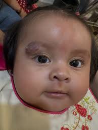 Qué son las Malformaciones Vasculares Capilares (Manchas de vino Oporto)?  🍷 🔹 Son anomalías de los vasos sanguíneos presentes desde el nacimiento.  🔹 También llamadas nevus flameus, angioma plano o mancha en