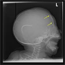 Copper beaten skull is a phenomenon wherein intense intracranial pressure disfigures the internal surface of the skull. Solution To Unknown Case 8 Luckenschadel Skull Versus Copper Beaten Skull Radiologypics Com