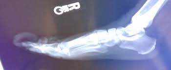 Image result for Onychogryphosis feet