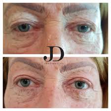 Plasma Fibroblasting Skin Tightening Jd Aesthetics