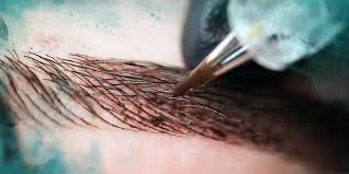 Can eyebrow tattoo be removed. Eyebrow Tattoo Removal Removery
