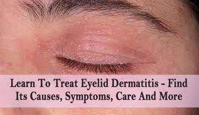 Learn To Treat Eyelid Dermatitis Find Its Causes Symptoms Care And More If You Ever Find That You Have Ey Eyelid Dermatitis Dermatitis Treatment Eye Eczema