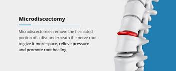 Trust your recovery to the experts! Spine Surgery When It Works And When It Doesn T Orthobethesda