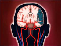 Watch the full video | create gif from this video. Detectan Mas Derrames Cerebrales En Pacientes Con Vih Bbc News Mundo