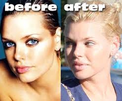 Celebrity Plastic Surgery Photos