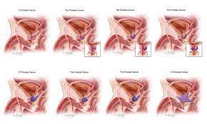 Though uncommon, the diagnosis of prostate cancer in transgender women is often associated with significant disease. Prostate Cancer Symptoms Diagnosis Treatment Urology Care Foundation