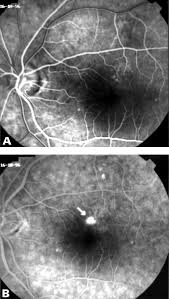 The incidence is around 10 in 10,000 individuals and is six times more likely to occur in men compared to women 1. Central Serous Retinopathy Complicated By Massive Bilateral Subretinal Haemorrhage Abstract Europe Pmc