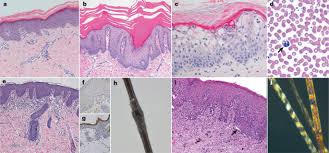 Image result for Ichthyosis