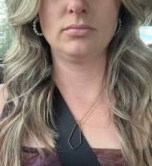 Kybella for double chin removal in 40s: effectiveness and alternatives