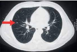 95% of nodules found are benign. 2d Ct Scan Slice Containing A Small 5mm Early Stage Lung Cancer Download Scientific Diagram