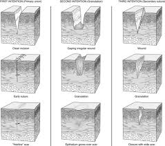 Basic wound cleaning step by step. 126 Cleaning Irrigating Culturing And Dressing An Open Wound Clinical Gate