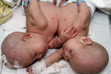 Mga resulta ng larawan para sa Fetus in Fetu Twins in a child"