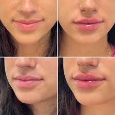 Ultimate Guide to Lip Fillers in Phoenix, AZ