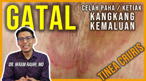 Larutkan satu sendok teh garam epsom kedalam segelas air hangat. Apa Itu Kudis Buta Scabies Ubat Dan Cara Merawat Kudis Buta Youtube