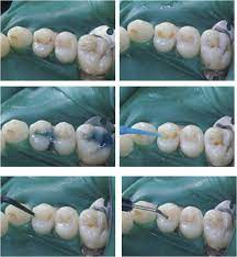 Plastic filling gambar 5 plastic filling e. Restorasi Preventif Resin Pada Pit Dan Fisur Den To Sca Notes
