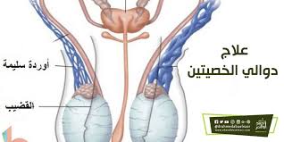 علاج دوالي الخصيتين